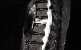Treating Osteoporotic Pain: Expert Interview Treating Osteoporotic Pain: Expert Interview