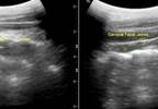 Cervical Facet Plane Block: The When, How, on Whom Cervical Facet Plane Block: The When, How, on Whom