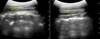 Cervical Facet Plane Block: The When, How, on Whom Cervical Facet Plane Block: The When, How, on Whom