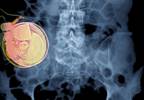 Intrathecal Drug Delivery Systems May Be Ineffective for Complex Regional Pain Syndrome Intrathecal Drug Delivery Systems May Be Ineffective for Complex Regional Pain Syndrome