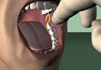 Buffered Lidocaine May Be Superior to Nonbuffered Lidocaine for Inferior Alveolar Nerve Block Buffered Lidocaine May Be Superior to Nonbuffered Lidocaine for Inferior Alveolar Nerve Block