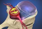 Transformainal Epidural Steroid Injection Superior to Caudal in Lumbosacral Disk Herniation Transformainal Epidural Steroid Injection Superior to Caudal in Lumbosacral Disk Herniation