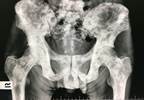 Oral Piroxicam Fast-Dissolving Tablets vs Sublingual Fentanyl for Bone Metastases-Related Pain Oral Piroxicam Fast-Dissolving Tablets vs Sublingual Fentanyl for Bone Metastases-Related Pain