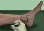 Predicting Success of Focal Nerve Surgery Based on Diagnostic Block Response Predicting Success of Focal Nerve Surgery Based on Diagnostic Block Response