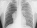 Spontaneous Pneumothorax Hospital Admissions Have Increased Spontaneous Pneumothorax Hospital Admissions Have Increased