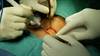 Patients Undergoing Thyroid Surgery May Require Few Opioids Patients Undergoing Thyroid Surgery May Require Few Opioids
