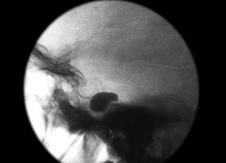 Patients with cranial nerve neuralgias and hemifacial spasm who cannot tolerate or do not respond to medication may benefit from interventional treatment, including percutaneous nerve destruction. Patients with cranial nerve neuralgias and hemifacial spasm who cannot tolerate or do not respond to medication may benefit from interventional treatment, including percutaneous nerve destruction.
