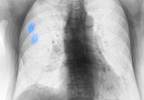 Pulsed Ultrasound May Be Effective for the Treatment of Rib Fractures Pulsed Ultrasound May Be Effective for the Treatment of Rib Fractures