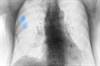 Pulsed Ultrasound May Be Effective for the Treatment of Rib Fractures Pulsed Ultrasound May Be Effective for the Treatment of Rib Fractures