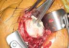 Comparable Analgesia With Local Infiltration Analgesia, Interscalene Nerve Block After Shoulder Arthroplasty Comparable Analgesia With Local Infiltration Analgesia, Interscalene Nerve Block After Shoulder Arthroplasty