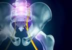 Methylprednisolone May Provide Short-Term Relief From Acute Diskogenic Sciatica Methylprednisolone May Provide Short-Term Relief From Acute Diskogenic Sciatica