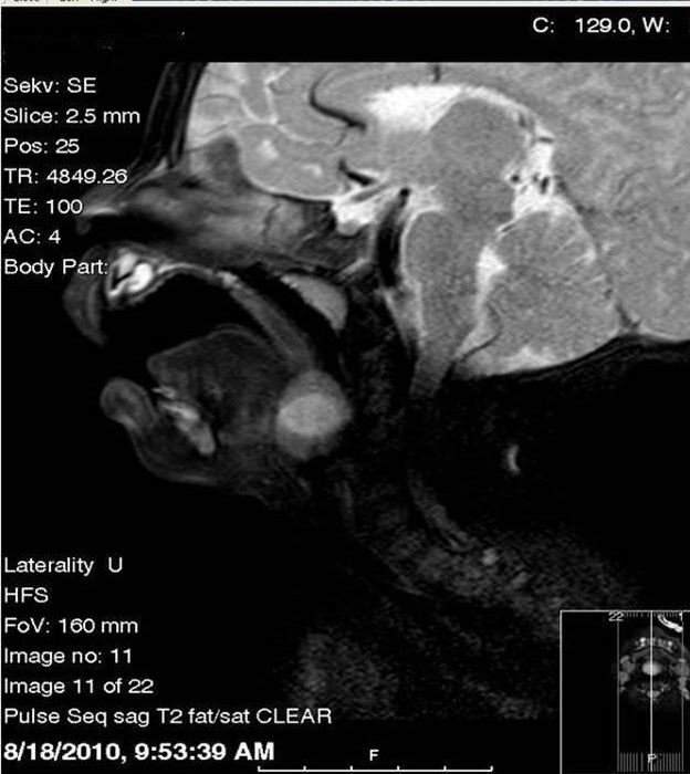 Congenital Cysts Involving Airway Vallecular Cyst Lingual