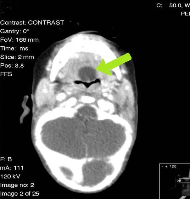 Congenital Cysts Involving Airway Vallecular Cyst Lingual